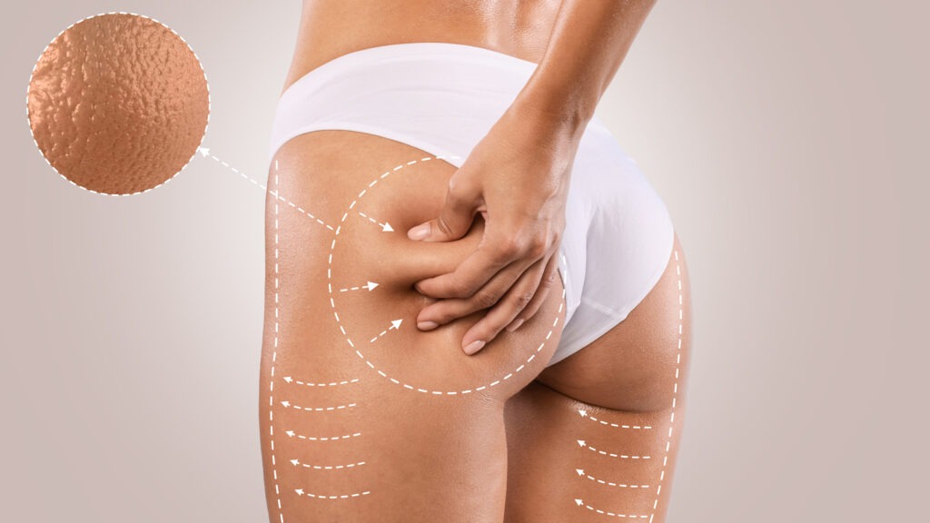 Combatti la Cellulite Mentre Dormi: Il Segreto Notturno per una Pelle Liscia